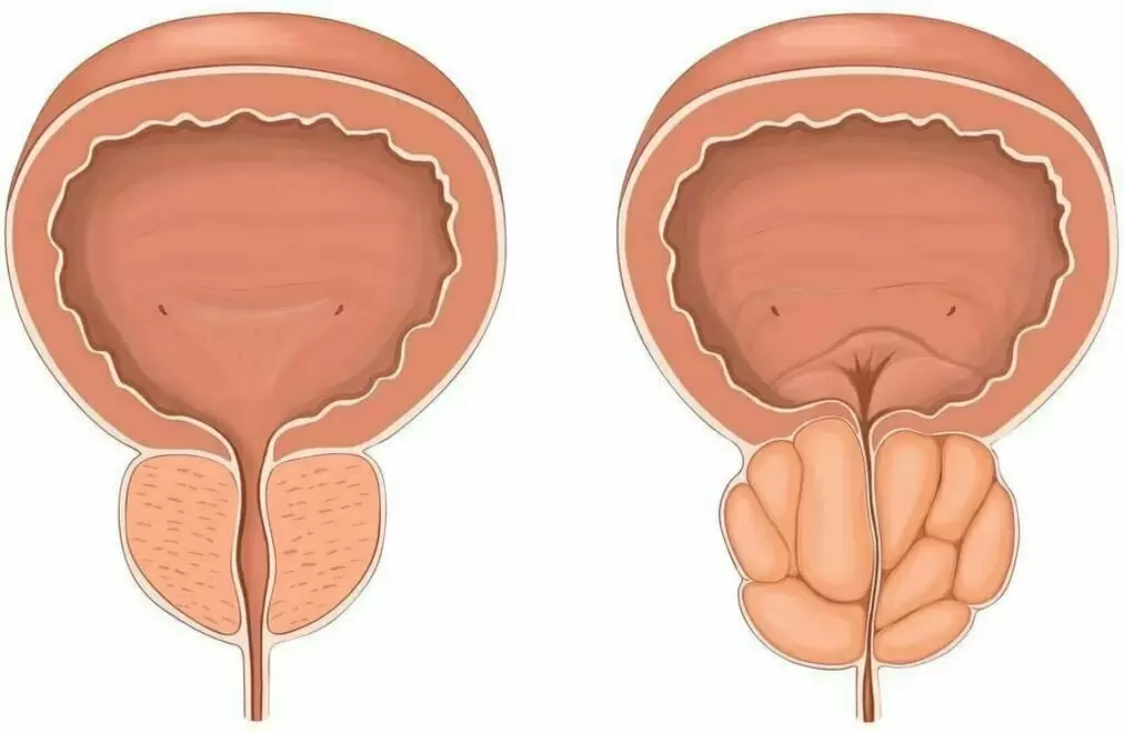 Próstata saudável e prostatite