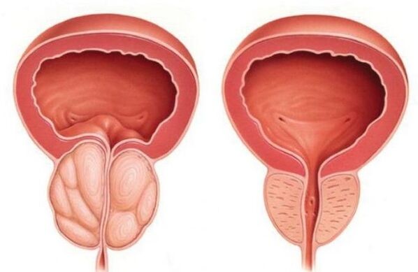 próstata normal e aumentada com prostatite